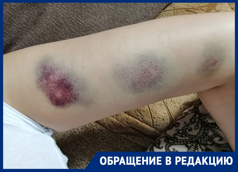 Мать двоих детей получила синяки после встречи с полицейским в Воронежской области Мать двоих детей получила синяки после встречи с полицейским в Воронежской области